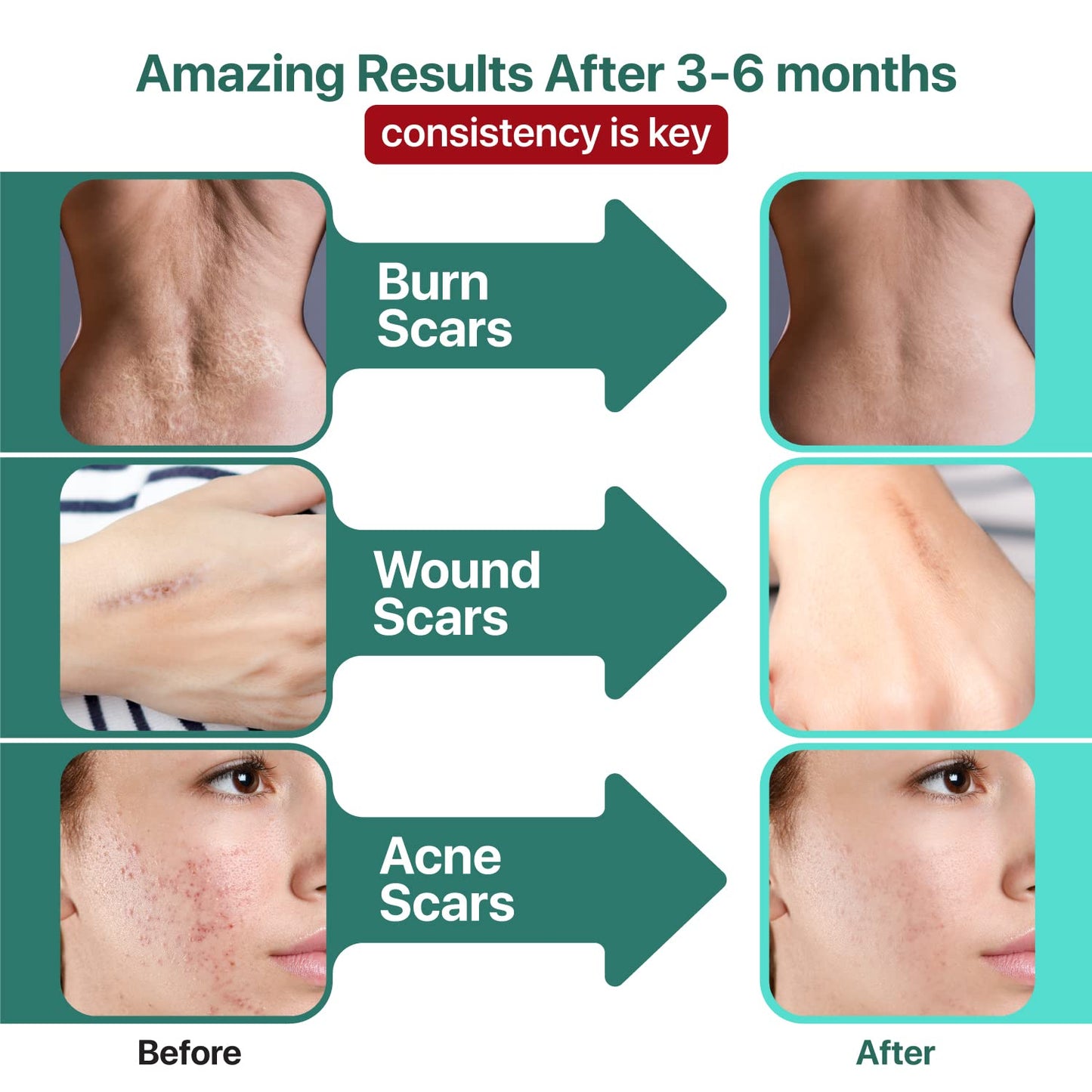 Ebanel Bundle of 30% AHA 2% BHA Chemical Peel and Advanced Silicone Scar Gel Ebanel buy supplements Au