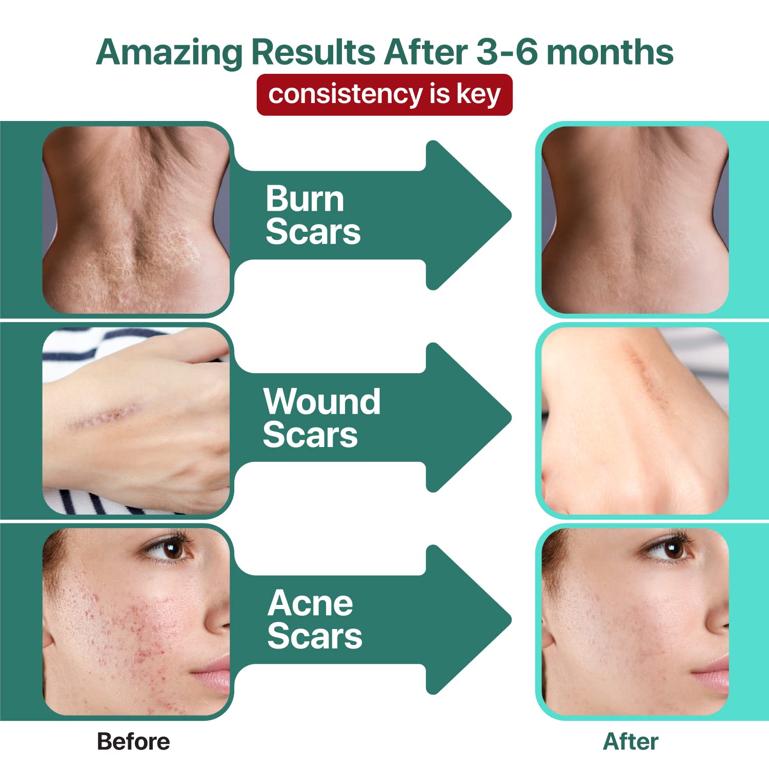 Ebanel Bundle of Advanced Silicone Scar Gel 1 Oz, and Hyaluronic Acid Serum Ebanel buy supplements Au