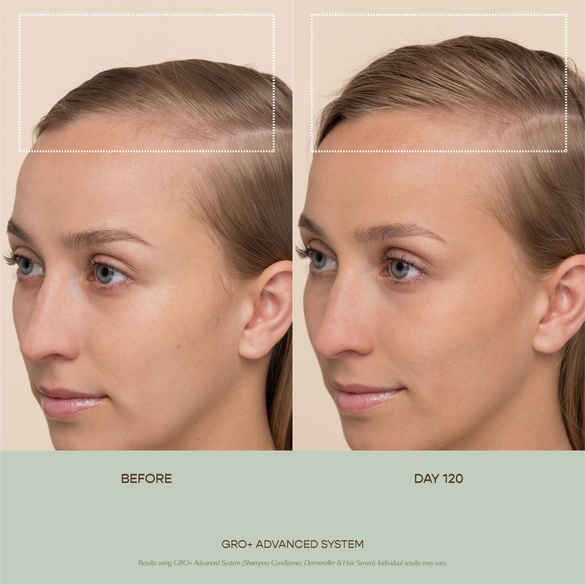 VEGAMOUR GRO+ Advanced Dermaroller | 1,200 Microneedle 0.25mm Scalp Tool | Gently Exfoliates the Scalp | Wide Head for Maximum Coverage VEGAMOURBuy Supplements Australia